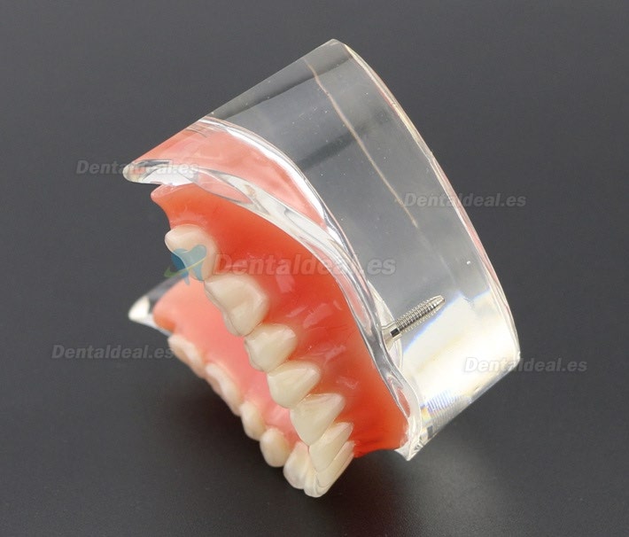 Dental Dientes inferiores Modelo de sobredentadura 2 Implantes Demostración Modelo 6002 01